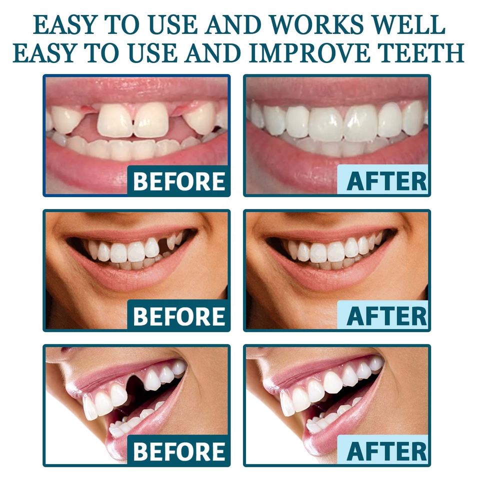 EELHOE Teeth Braces Adjustable Snap on Smile Teeth Veneers