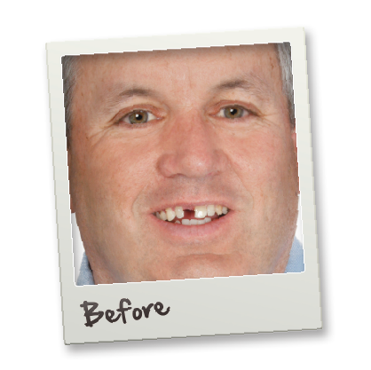1 Pair Snap on Teeth Veneers for Men and Women